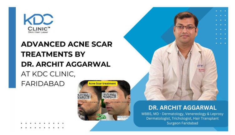 Advanced Acne Scar Treatments by Dr. Archit Aggarwal at KDC Clinic, Faridabad