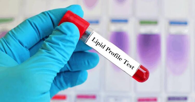 Why Regular Lipid Profile Tests Are Crucial for Heart Health