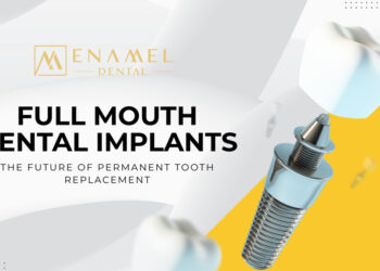 Why Full Mouth Dental Implants Are the Future of Permanent Tooth Replacement